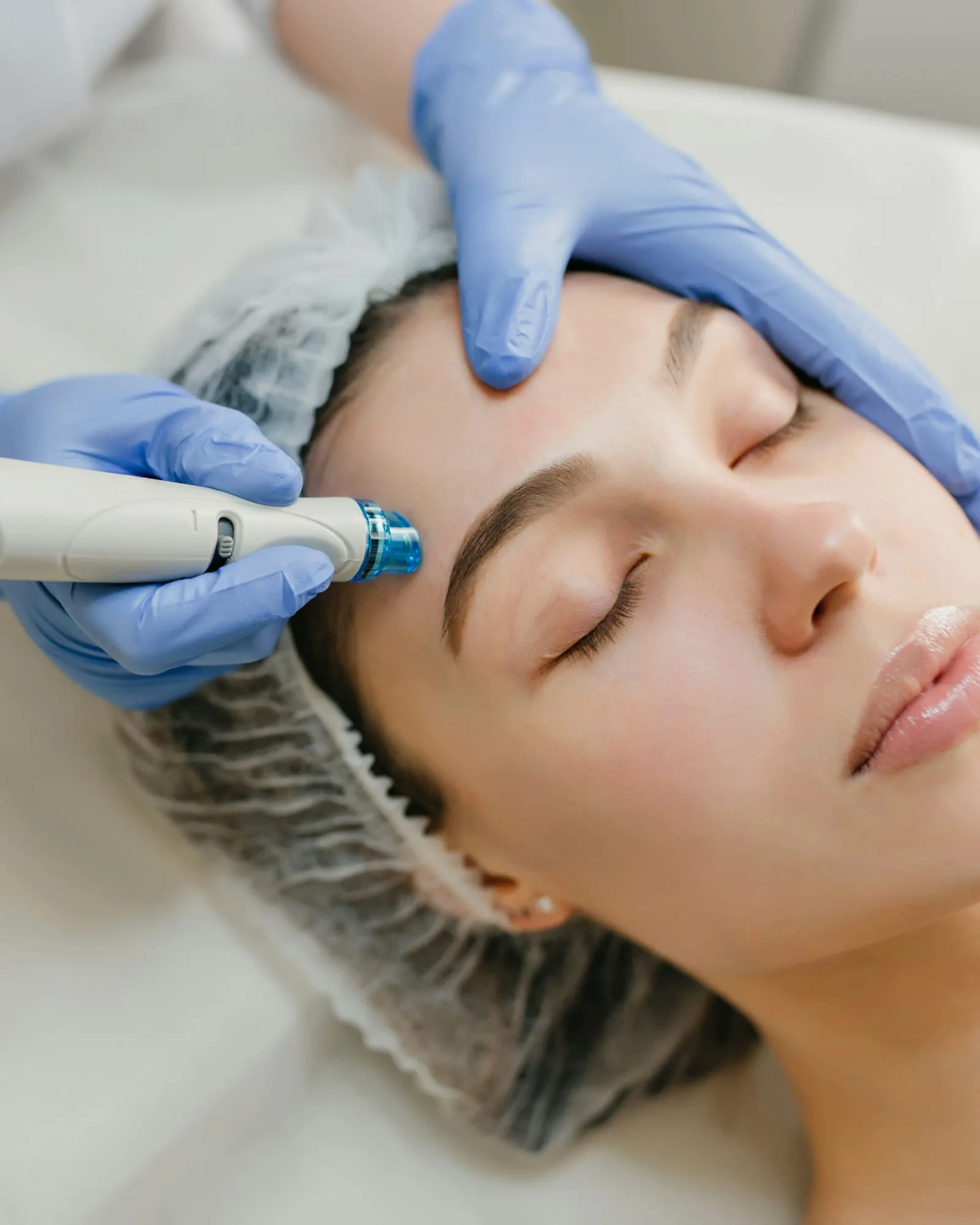 Dermapen (Mikroiğneleme)